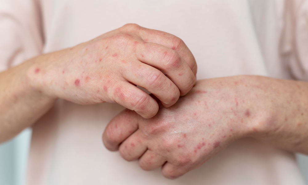 Sintomas e causas da dermatite atópica nos dias de frio